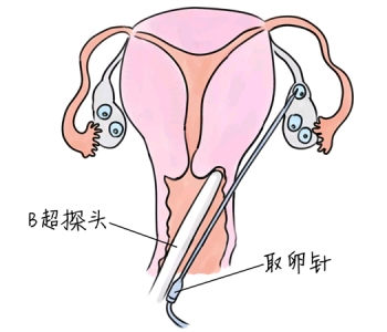 小儿退烧推拿手法 5种沈阳捐卵宝宝退烧按摩方法